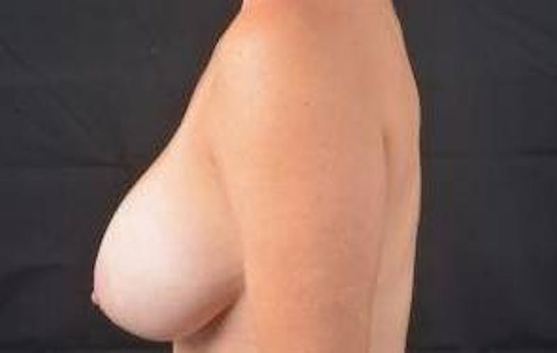 Breast Augmentation Mastopexy Before & After Gallery - Patient 319557 - Image 3