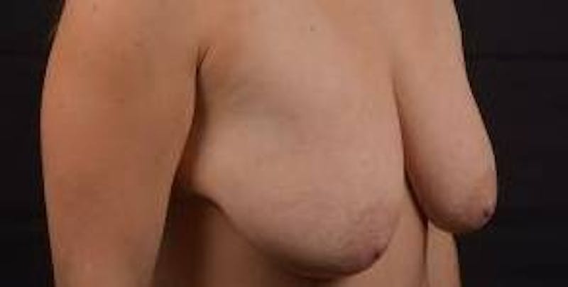 Mastopexy Before & After Gallery - Patient 185322 - Image 9