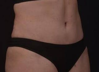 Brazillian Butt Lift Before & After Gallery - Patient 588091 - Image 4