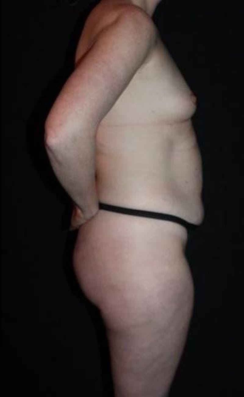 360 Liposuction Before & After Gallery - Patient 153794 - Image 11