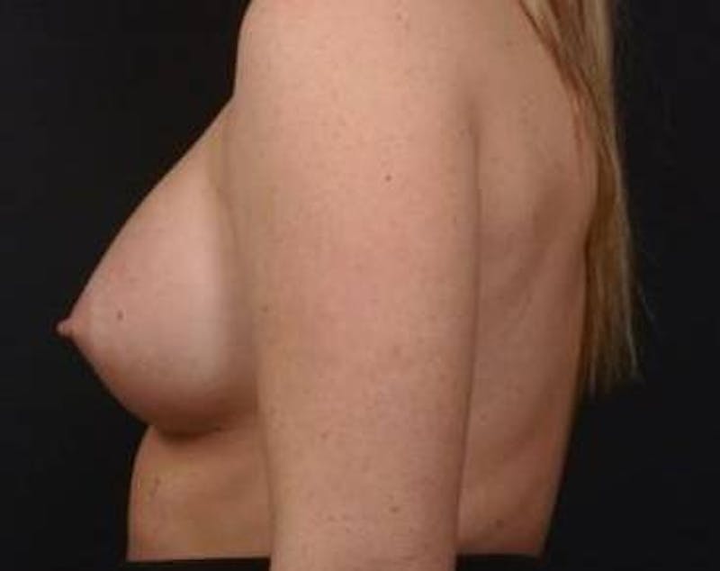 Breast Augmentation Silicone Gel Before & After Gallery - Patient 255945 - Image 4