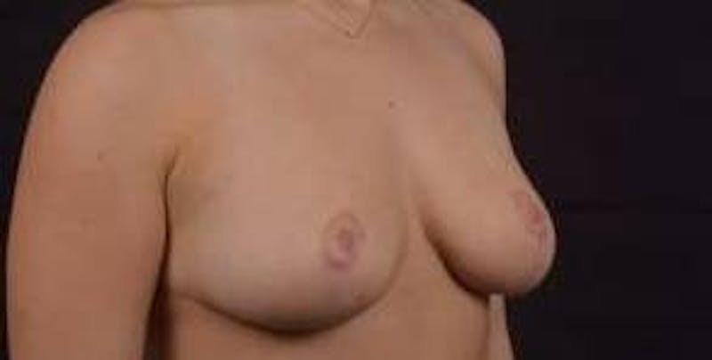 Mastopexy Before & After Gallery - Patient 185322 - Image 10