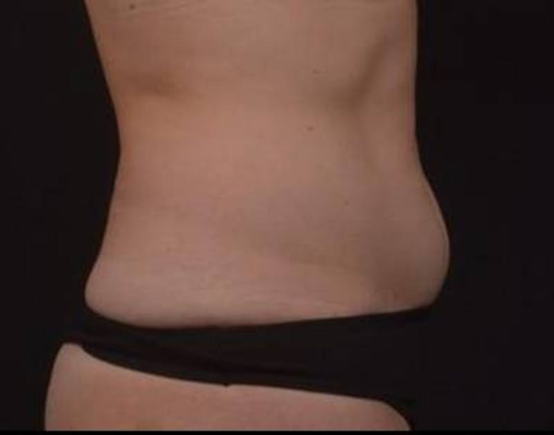Brazillian Butt Lift Before & After Gallery - Patient 588091 - Image 7