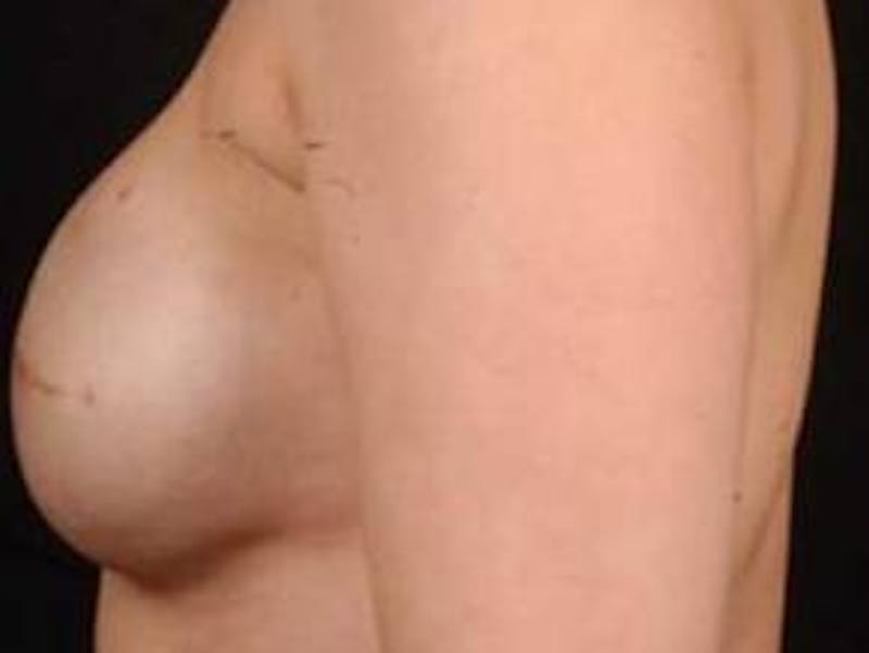 Reconstructive Breast Revision Before & After Gallery - Patient 112376 - Image 3