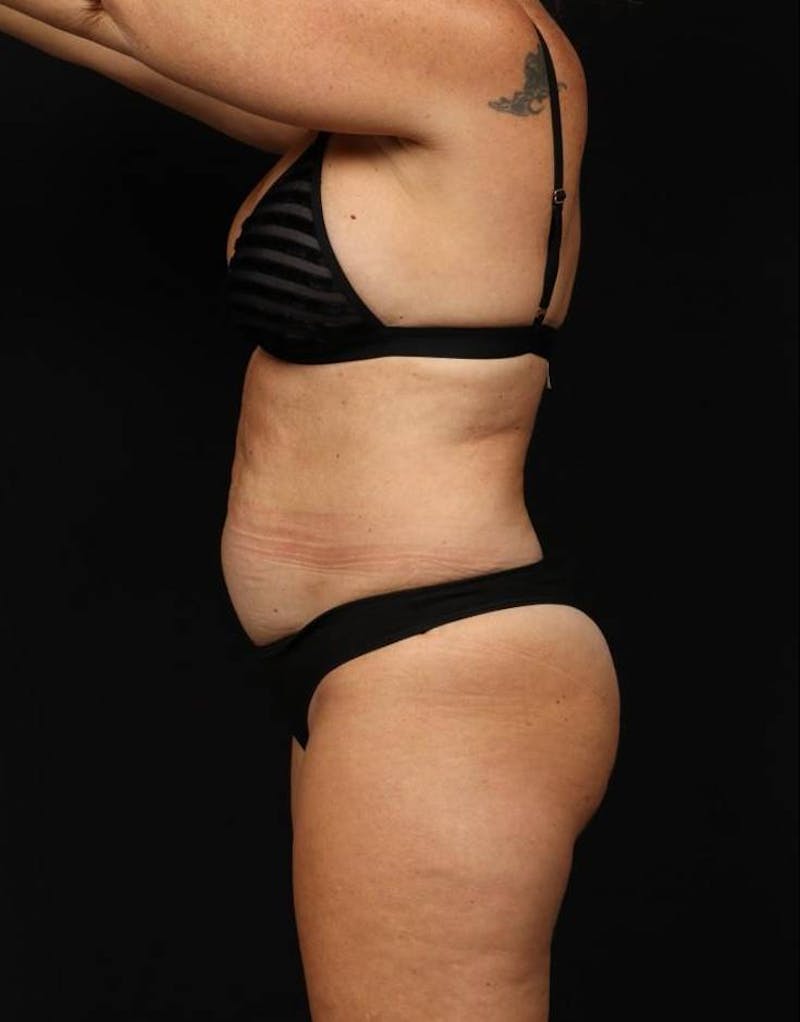 360 Liposuction Before & After Gallery - Patient 513562 - Image 5