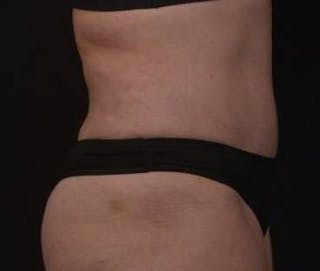 Brazillian Butt Lift Before & After Gallery - Patient 588091 - Image 8