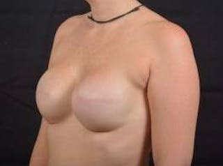 Immediate Breast Reconstruction – Skin Sparing Before & After Gallery - Patient 150575 - Image 8