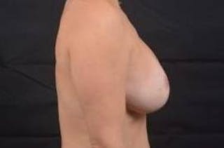 Breast Augmentation Mastopexy Before & After Gallery - Patient 319557 - Image 6
