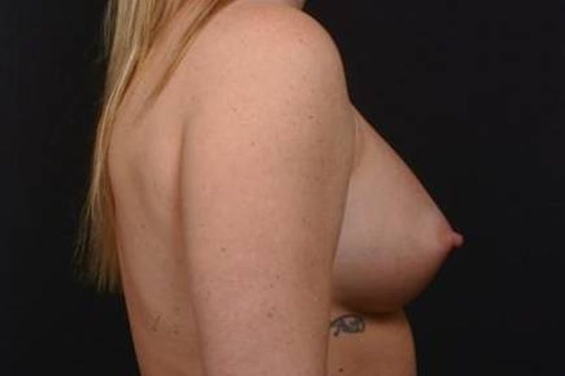 Breast Augmentation Silicone Gel Before & After Gallery - Patient 255945 - Image 6
