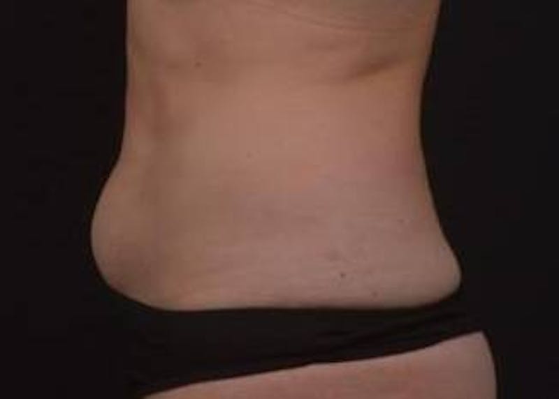 Brazillian Butt Lift Before & After Gallery - Patient 588091 - Image 9