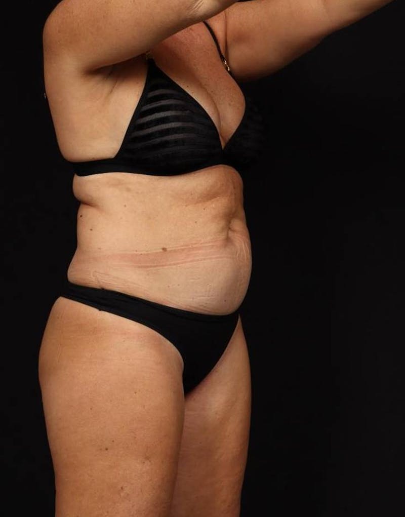 360 Liposuction Before & After Gallery - Patient 513562 - Image 7