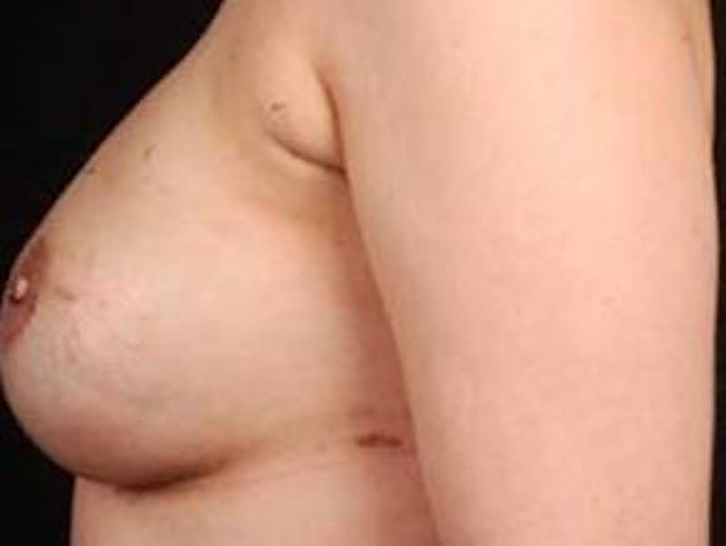 Reconstructive Breast Revision Before & After Gallery - Patient 112376 - Image 4