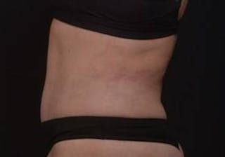 Brazillian Butt Lift Before & After Gallery - Patient 588091 - Image 10