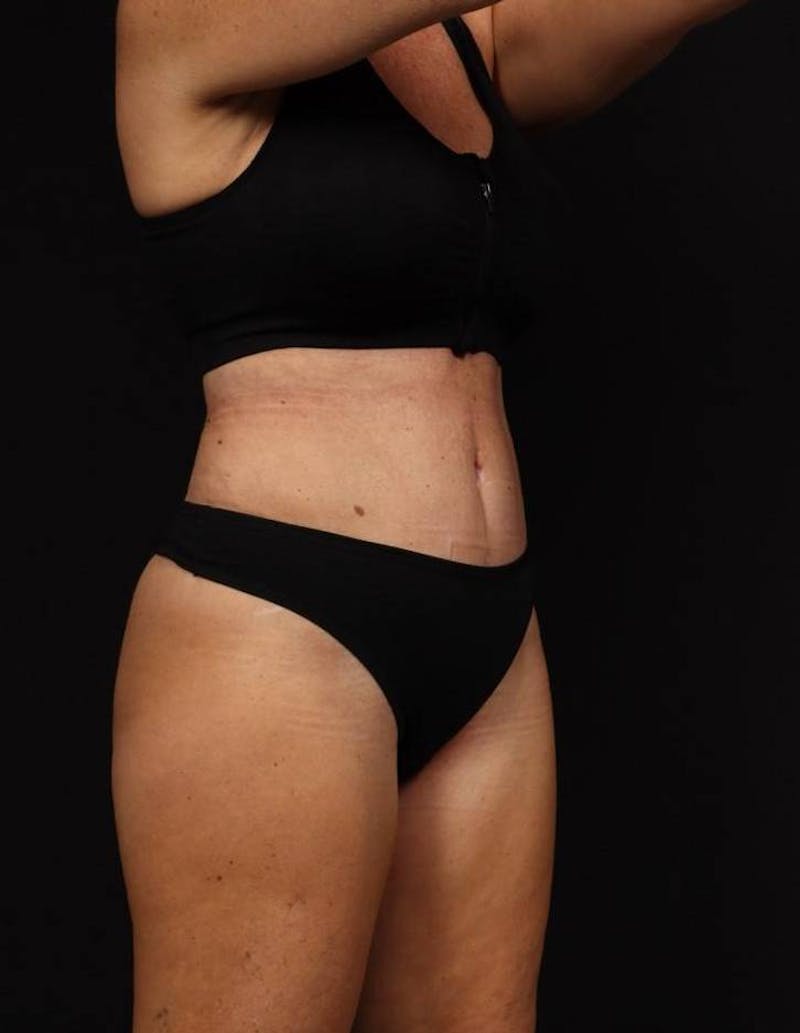 360 Liposuction Before & After Gallery - Patient 513562 - Image 8
