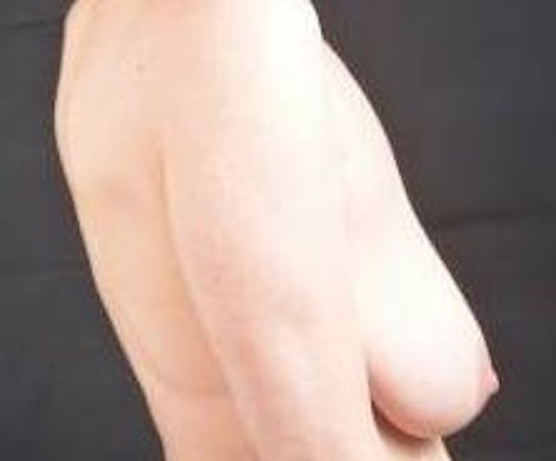 Mastopexy Before & After Gallery - Patient 254841 - Image 5