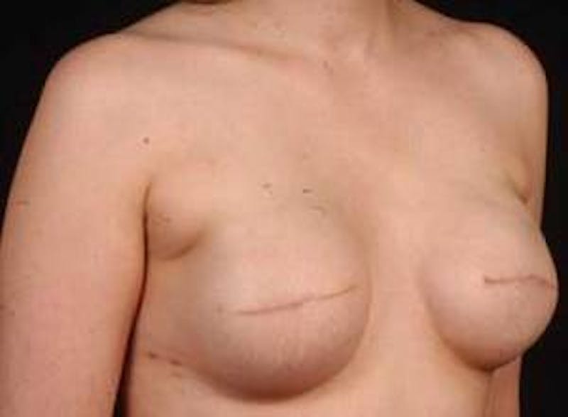 Reconstructive Breast Revision Before & After Gallery - Patient 112376 - Image 5