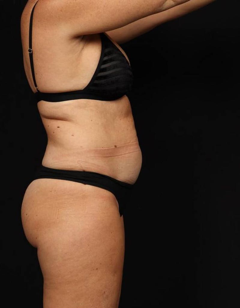 360 Liposuction Before & After Gallery - Patient 513562 - Image 9