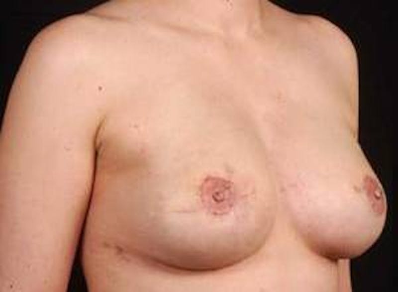 Reconstructive Breast Revision Before & After Gallery - Patient 112376 - Image 6