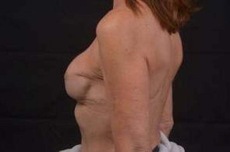 Aesthetic Breast Revision Before & After Gallery - Patient 360015 - Image 3