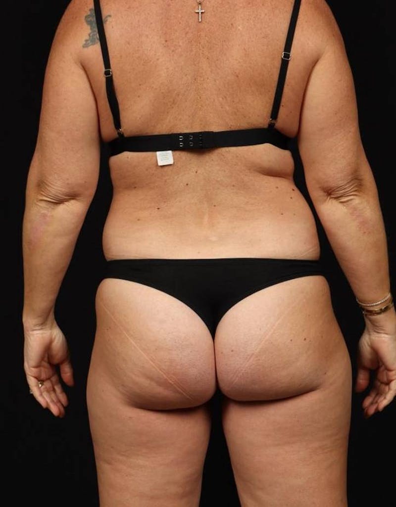 360 Liposuction Before & After Gallery - Patient 513562 - Image 11