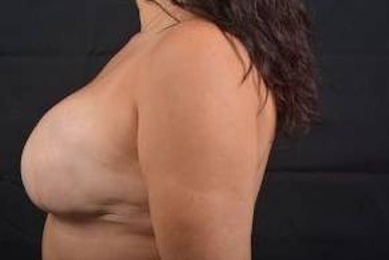 Immediate Breast Reconstruction – Skin Sparing Before & After Gallery - Patient 339397 - Image 4