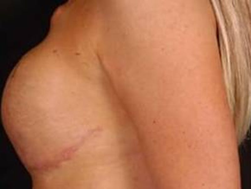 Reconstructive Breast Revision Before & After Gallery - Patient 120405 - Image 3