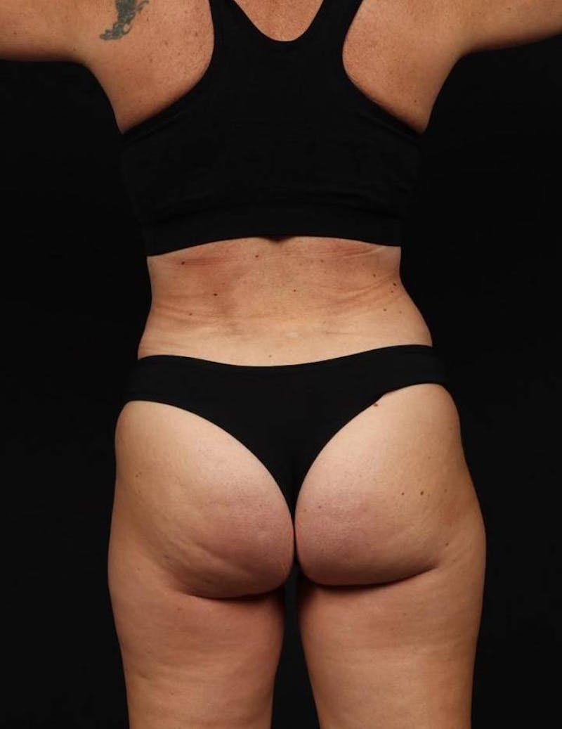 360 Liposuction Before & After Gallery - Patient 513562 - Image 12