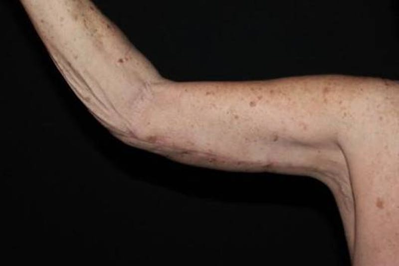 Arm Lift (Brachioplasty) Before & After Gallery - Patient 126242 - Image 4