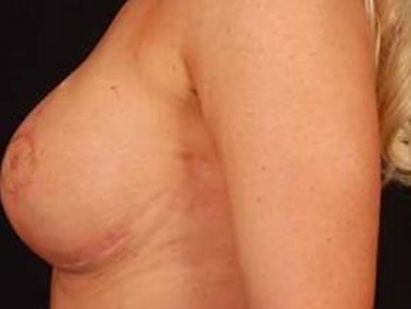 Reconstructive Breast Revision Before & After Gallery - Patient 120405 - Image 4