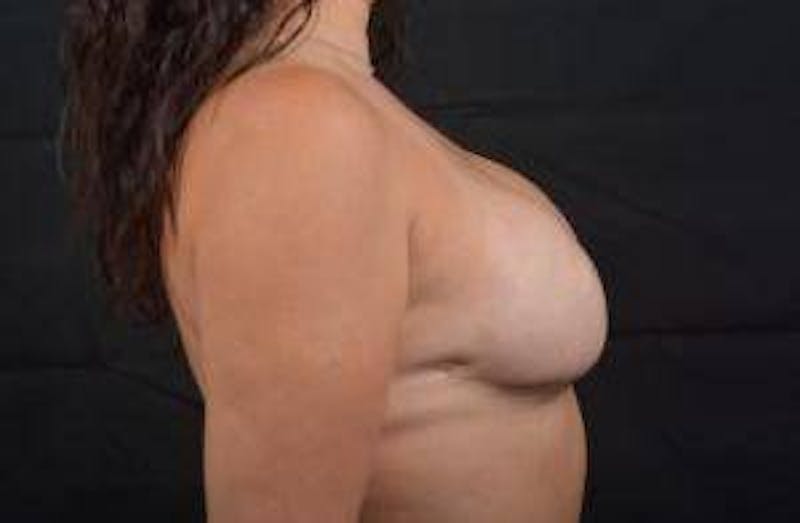 Immediate Breast Reconstruction – Skin Sparing Before & After Gallery - Patient 339397 - Image 6