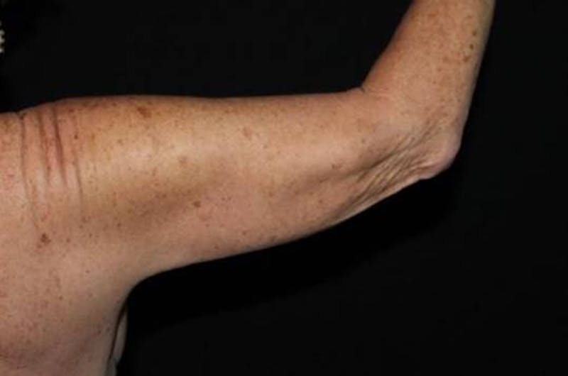 Arm Lift (Brachioplasty) Before & After Gallery - Patient 126242 - Image 5