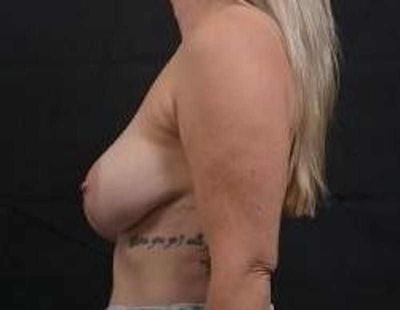 Breast Augmentation Mastopexy Before & After Gallery - Patient 239720 - Image 3