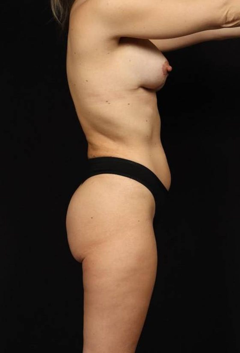 Brazillian Butt Lift Before & After Gallery - Patient 980762 - Image 10