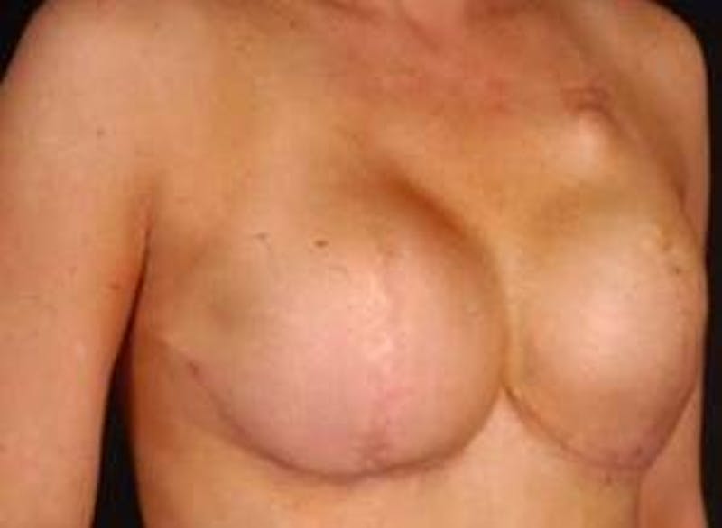 Reconstructive Breast Revision Before & After Gallery - Patient 120405 - Image 5