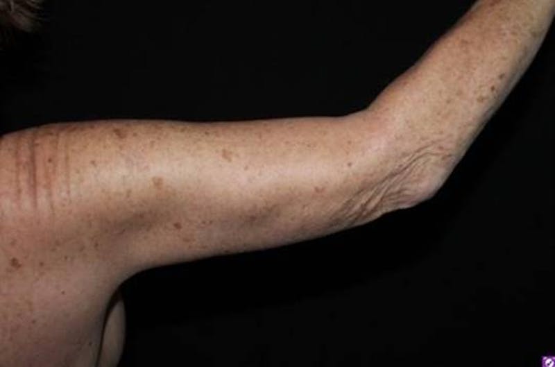 Arm Lift (Brachioplasty) Before & After Gallery - Patient 126242 - Image 6