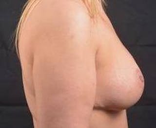 Mastopexy Before & After Gallery - Patient 163580 - Image 6