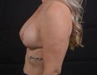 Breast Augmentation Mastopexy Before & After Gallery - Patient 239720 - Image 4