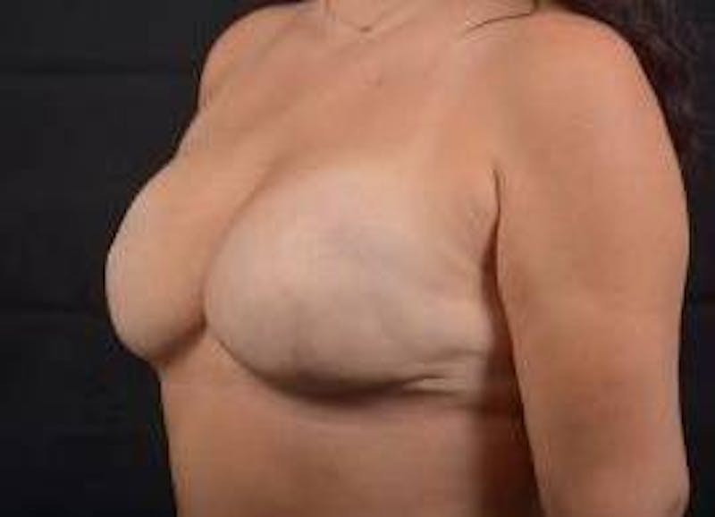 Immediate Breast Reconstruction – Skin Sparing Before & After Gallery - Patient 339397 - Image 8