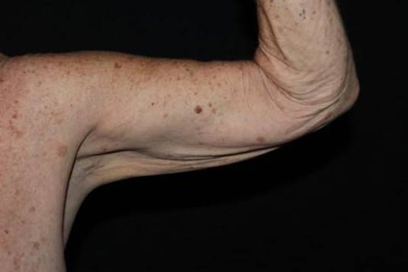 Arm Lift (Brachioplasty) Before & After Gallery - Patient 126242 - Image 7