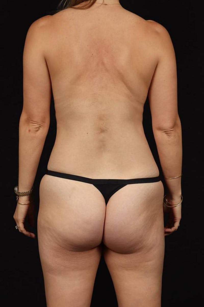 360 Liposuction Before & After Gallery - Patient 218185 - Image 11