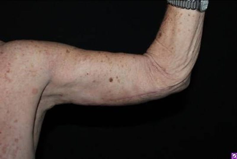 Arm Lift (Brachioplasty) Before & After Gallery - Patient 126242 - Image 8