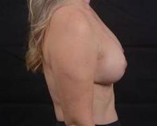 Breast Augmentation Mastopexy Before & After Gallery - Patient 239720 - Image 6
