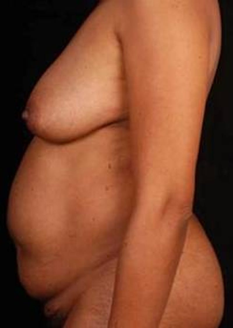 Mastopexy Before & After Gallery - Patient 111446 - Image 3