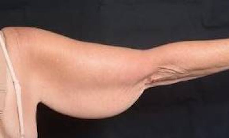 Arm Lift (Brachioplasty) Before & After Gallery - Patient 104170 - Image 3
