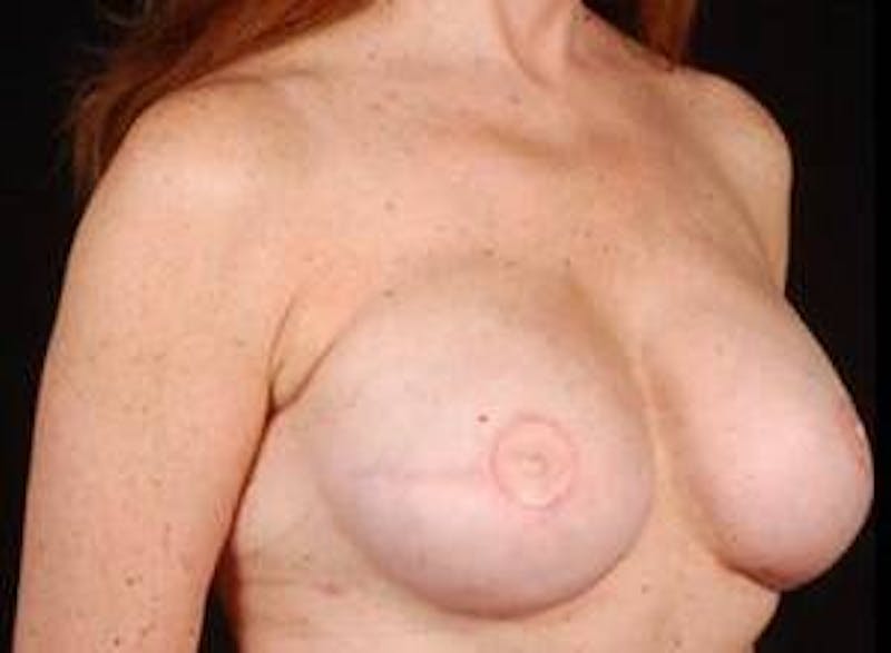Reconstructive Breast Revision Before & After Gallery - Patient 358529 - Image 6