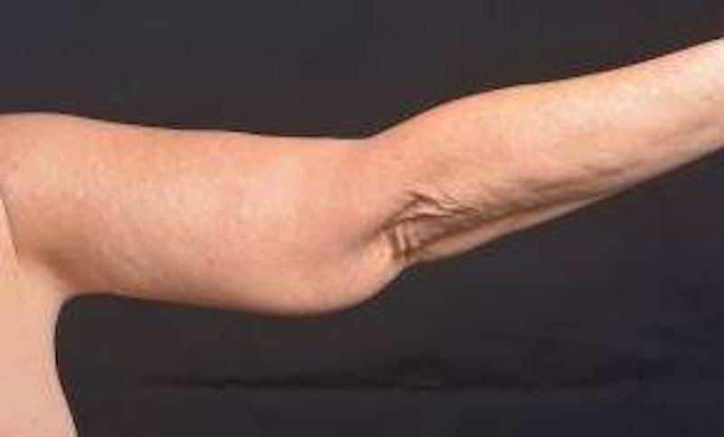 Arm Lift (Brachioplasty) Before & After Gallery - Patient 104170 - Image 4