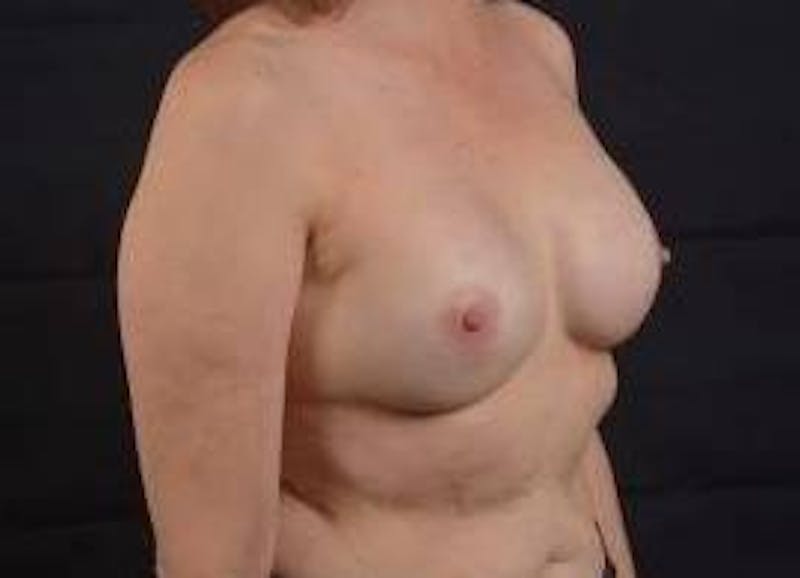 Immediate Breast Reconstruction – Nipple Sparing Before & After Gallery - Patient 317102 - Image 10