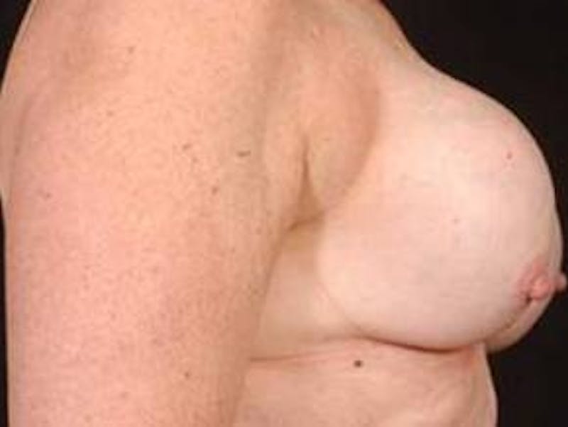 Reconstructive Breast Revision Before & After Gallery - Patient 343310 - Image 3
