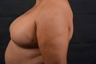 Immediate Breast Reconstruction – Skin Sparing Before & After Gallery - Patient 229008 - Image 4