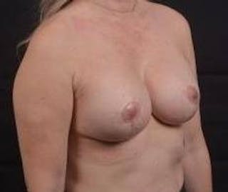 Breast Augmentation Mastopexy Before & After Gallery - Patient 239720 - Image 10